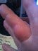 Cat bite on hand -- swollen