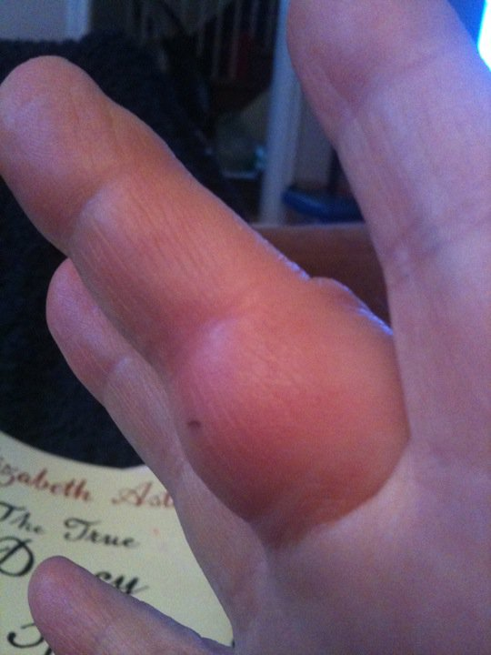 Cat bite on hand -- swollen