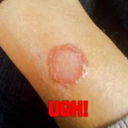 Ringworm on person's arm