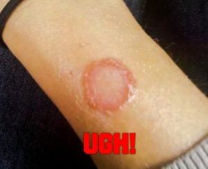 Ringworm on person's arm