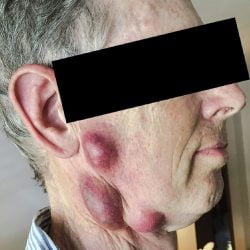 Feline tularemia caused glandular tularemia in this man