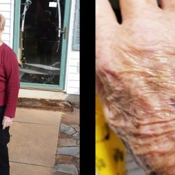 Kathy Brautigam and cat bite