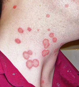 Ringworm on person's neck