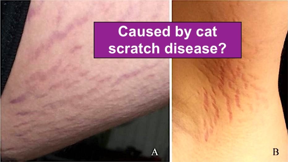 Stretch marks caused by cat scratch disease?