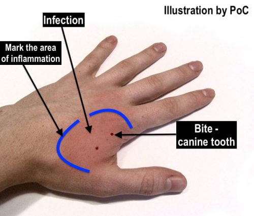 Marking the area of inflammation from a cat bite
