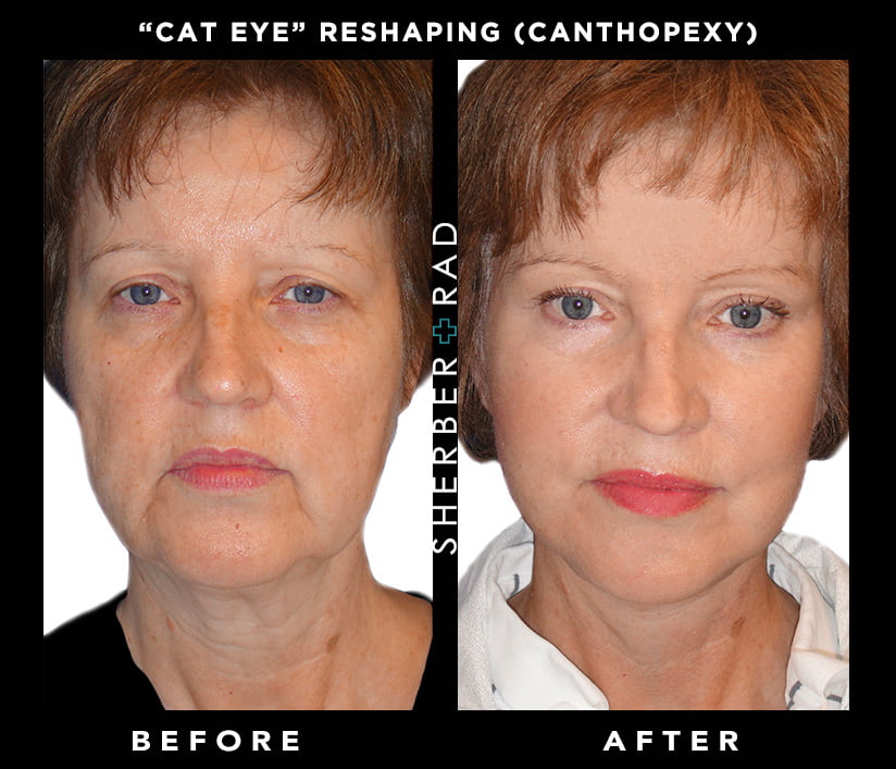 Cat eye surgery shaping